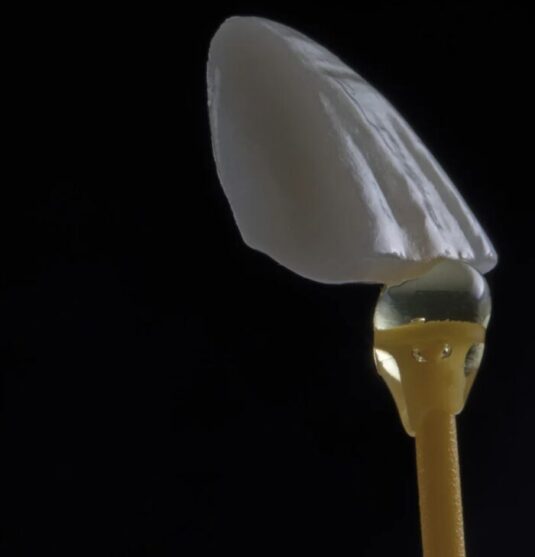 Porcelain veneers in Towson MD at Smithberger DDS